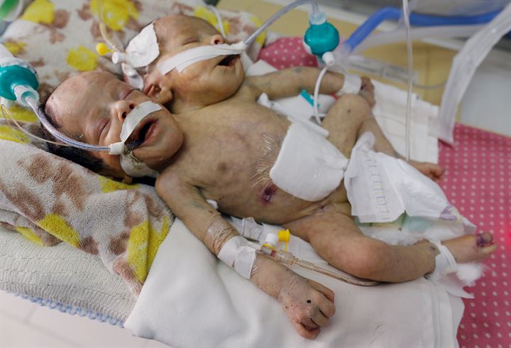 Yemende yeni doğan yapışık ikizler hayatını kaybetti - 9