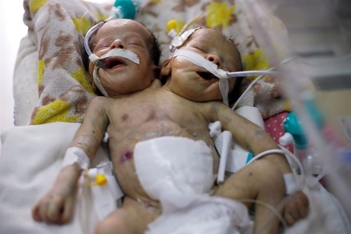 Yemende yeni doğan yapışık ikizler hayatını kaybetti - 11