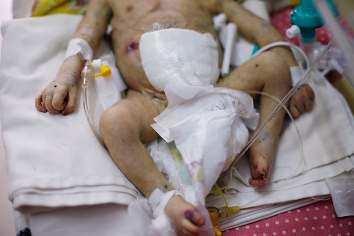 Yemende yeni doğan yapışık ikizler hayatını kaybetti - 10