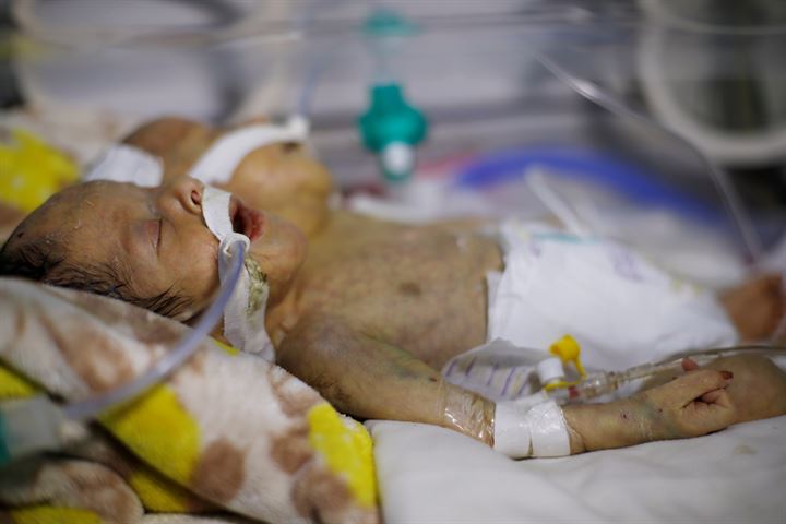 Yemende yeni doğan yapışık ikizler hayatını kaybetti - 15