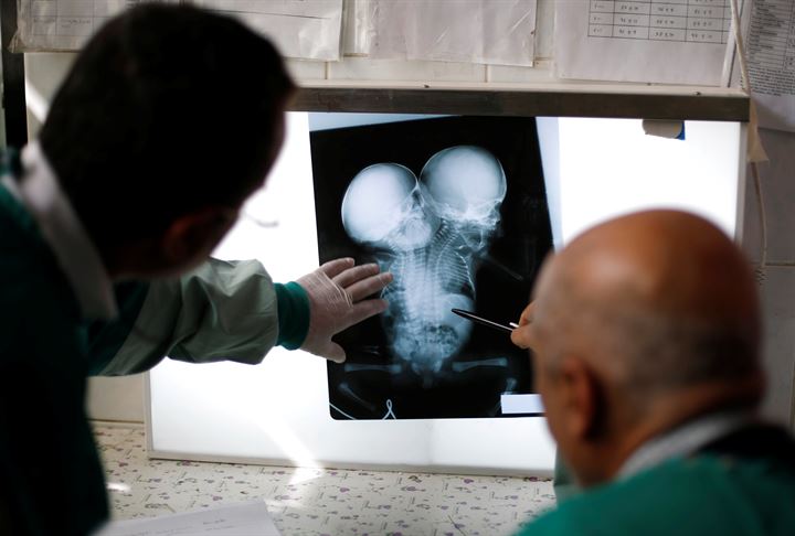 Yemende yeni doğan yapışık ikizler hayatını kaybetti - 16