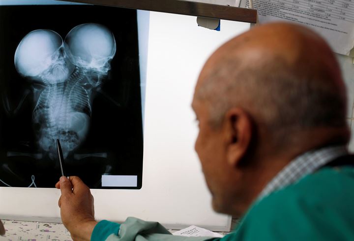 Yemende yeni doğan yapışık ikizler hayatını kaybetti - 17