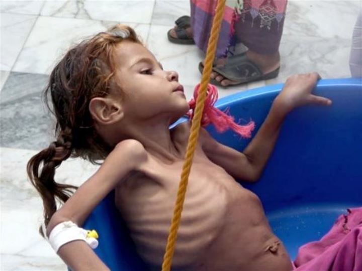 12 yaşında olan Fatima 10 kiloya kadar düştü - 7