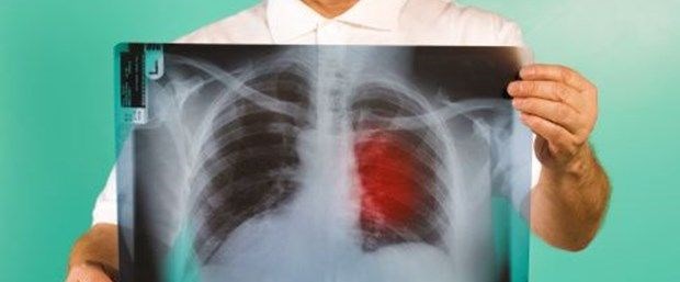 Göğüs ağrısının önemli 5 nedeni - 4