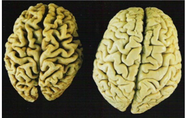 Beyin hakkında şaşırtıcı gerçekler - 11