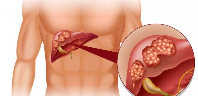 Karaciğerdeki bu yağlanma organ nakline götürebilir - 5