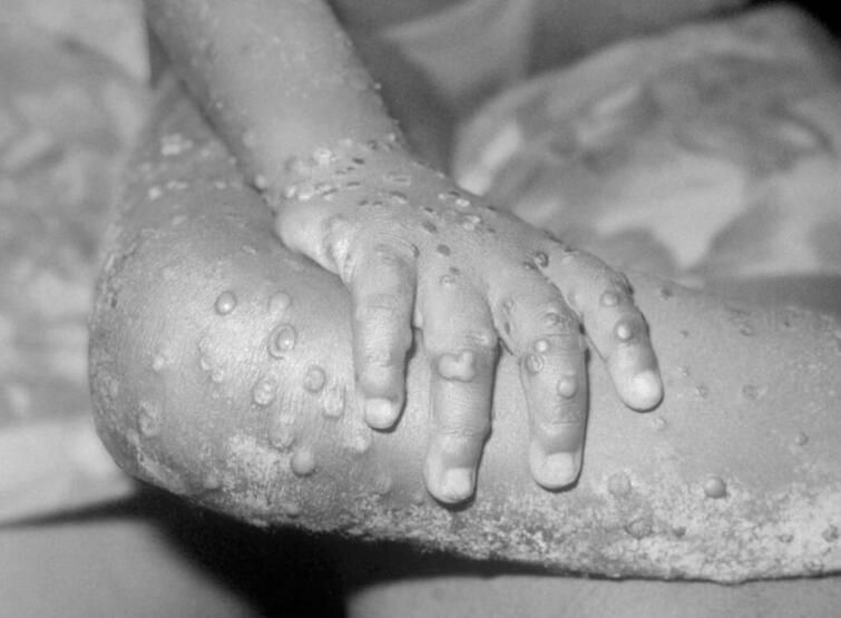 Rusya’da ilk maymun çiçeği vakası görüldü - 3