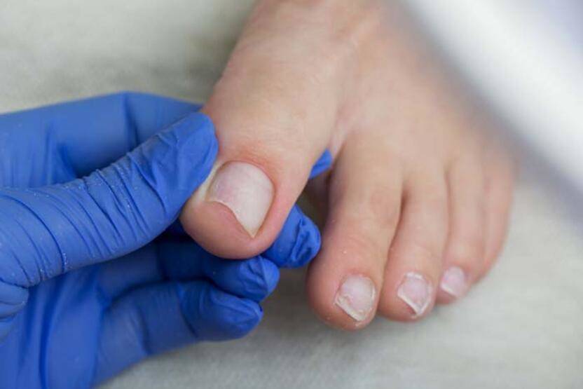 Diyabetin ilk belirtisi tırnaklarda ortaya çıkıyor! İşte kan şekeri hastalığının ilk işareti... - 2