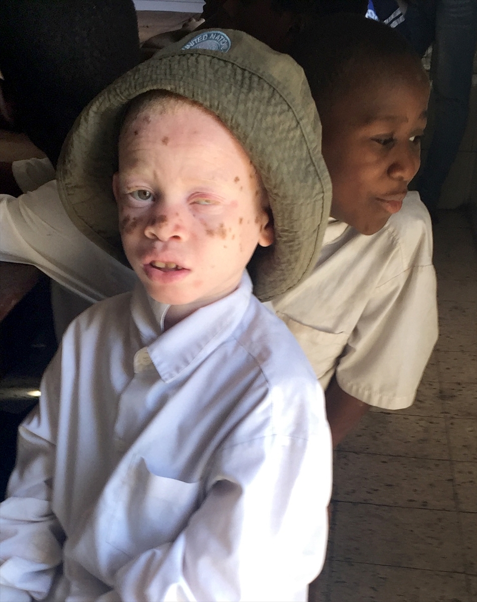 Afrika'nın beyaz insanları: Albinolar - 880