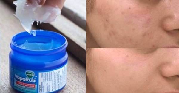 Vicks'in bilinmeyen 12 faydası - 10