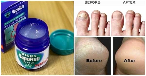 Vicks'in bilinmeyen 12 faydası - 4