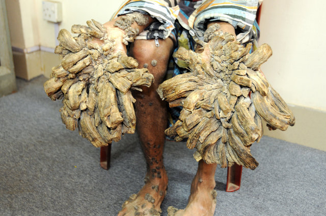 'Ağaç adam' tedavi oldu! - 1