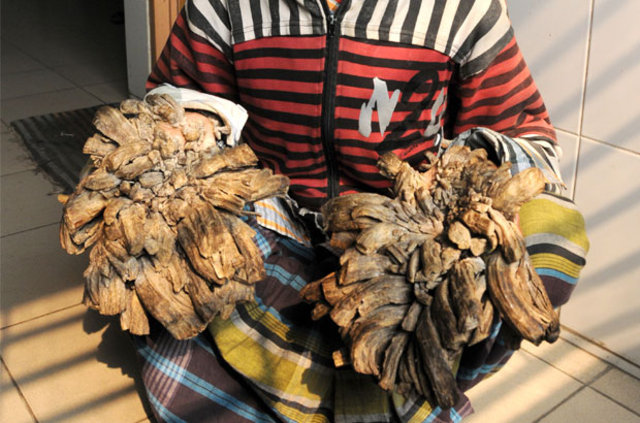 'Ağaç adam' tedavi oldu! - 3