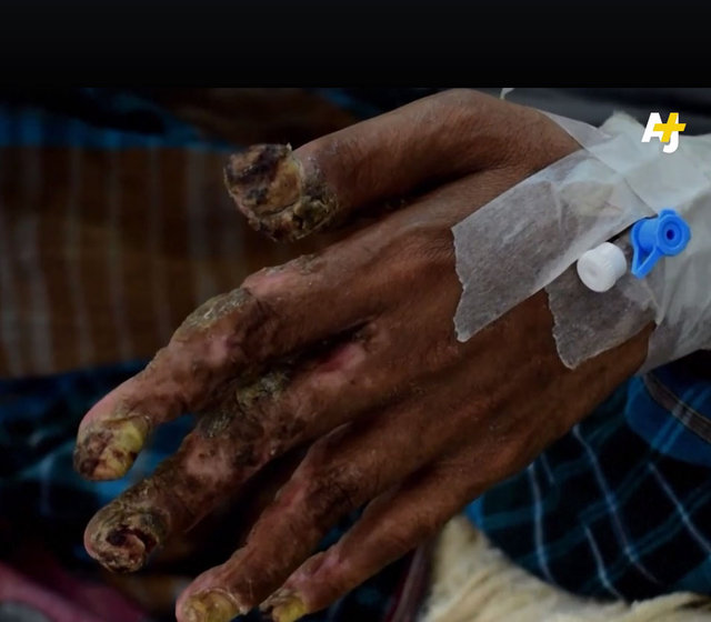 'Ağaç adam' tedavi oldu! - 6