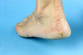 Topuk çatlamasına dikkat! Ölümcül bir hastalığın belirtisi olabilir - 4