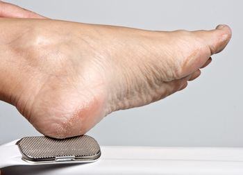 Topuk çatlamasına dikkat! Ölümcül bir hastalığın belirtisi olabilir - 5