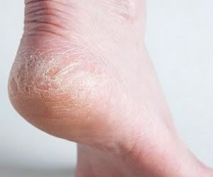 Topuk çatlamasına dikkat! Ölümcül bir hastalığın belirtisi olabilir - 7