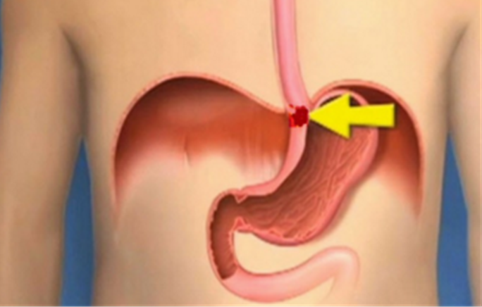 Topuk çatlamasına dikkat! Ölümcül bir hastalığın belirtisi olabilir - 8