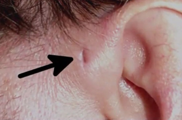 İnsan kulağının üzerinde yer alan delik nedir? - 6