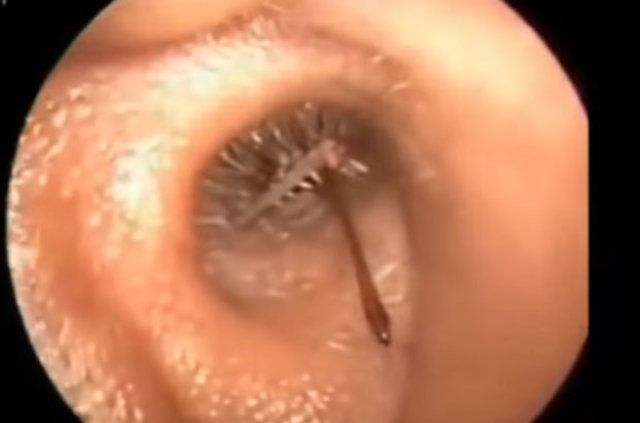 Kulağından öyle bir şey çıktı ki... - 1