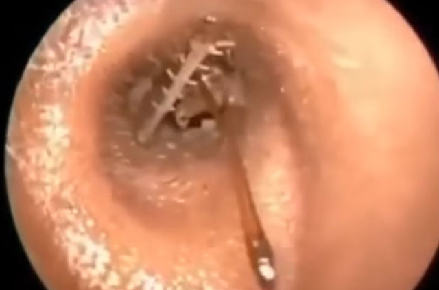 Kulağından öyle bir şey çıktı ki... - 2