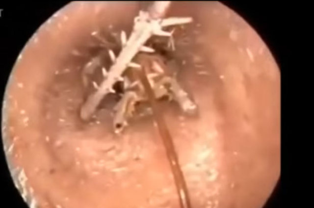 Kulağından öyle bir şey çıktı ki... - 5