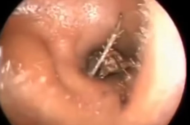 Kulağından öyle bir şey çıktı ki... - 8