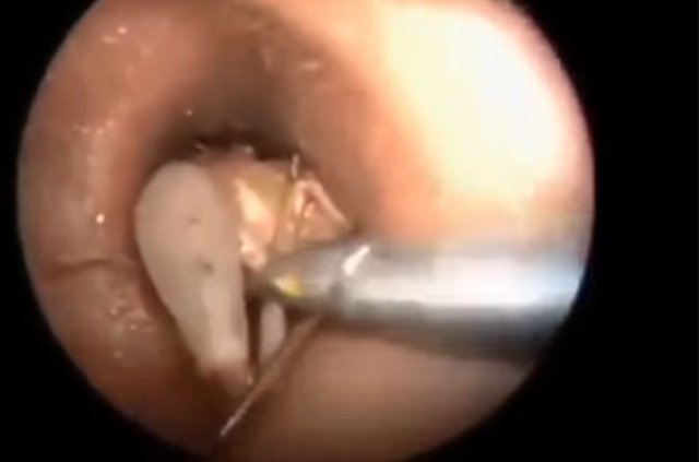 Kulağından öyle bir şey çıktı ki... - 15