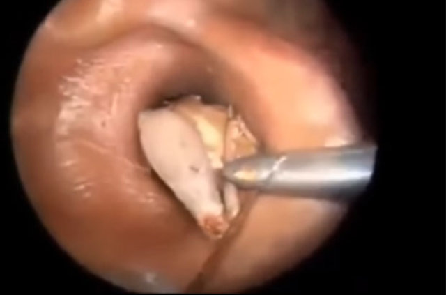 Kulağından öyle bir şey çıktı ki... - 16