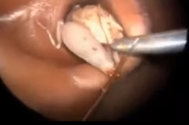 Kulağından öyle bir şey çıktı ki... - 17