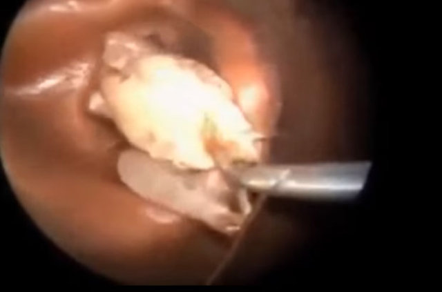 Kulağından öyle bir şey çıktı ki... - 18