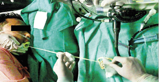 Midesinden tam 183 santimlik kurt çıkardılar! - 1