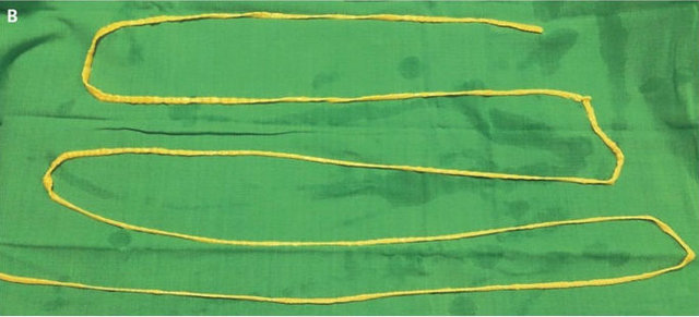 Midesinden tam 183 santimlik kurt çıkardılar! - 2