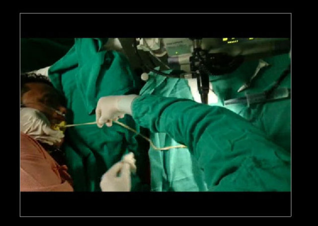 Midesinden tam 183 santimlik kurt çıkardılar! - 5