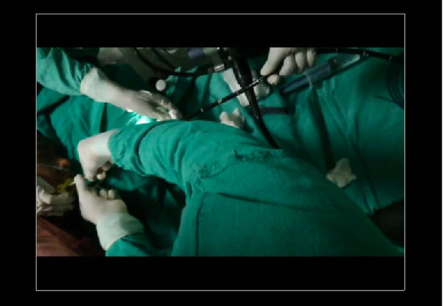 Midesinden tam 183 santimlik kurt çıkardılar! - 6