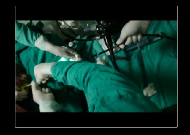 Midesinden tam 183 santimlik kurt çıkardılar! - 7