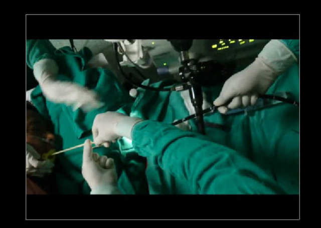 Midesinden tam 183 santimlik kurt çıkardılar! - 8