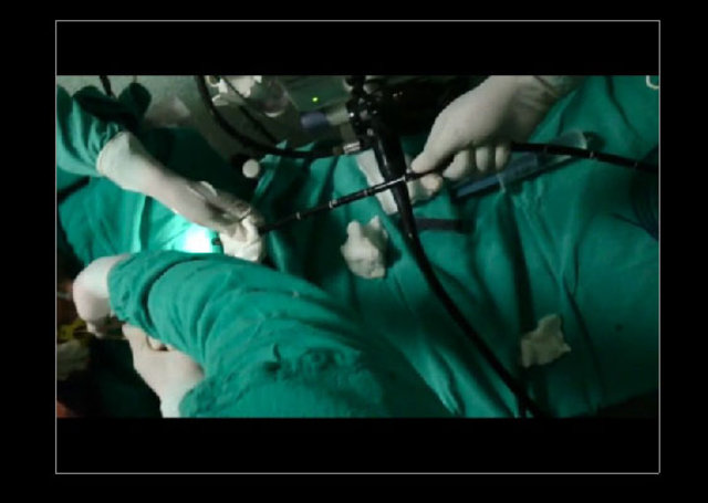 Midesinden tam 183 santimlik kurt çıkardılar! - 4