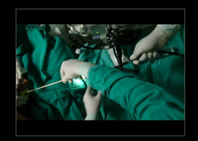 Midesinden tam 183 santimlik kurt çıkardılar! - 9