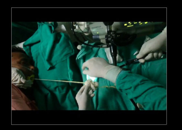 Midesinden tam 183 santimlik kurt çıkardılar! - 12