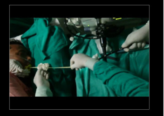 Midesinden tam 183 santimlik kurt çıkardılar! - 10