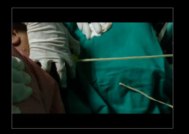 Midesinden tam 183 santimlik kurt çıkardılar! - 15