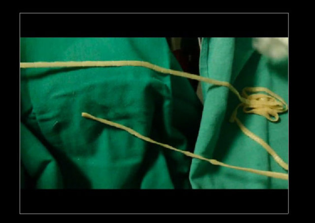 Midesinden tam 183 santimlik kurt çıkardılar! - 16