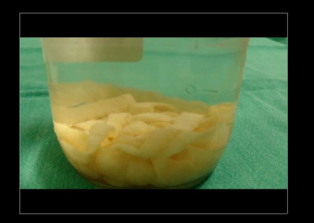 Midesinden tam 183 santimlik kurt çıkardılar! - 18