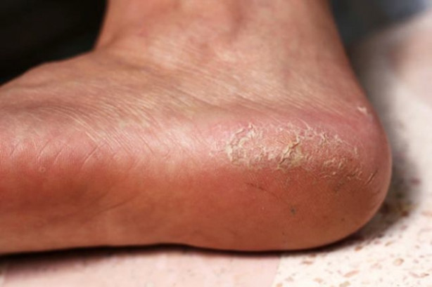 Topuk çatlakları ölümcül hastalığın belirtisi! - 1