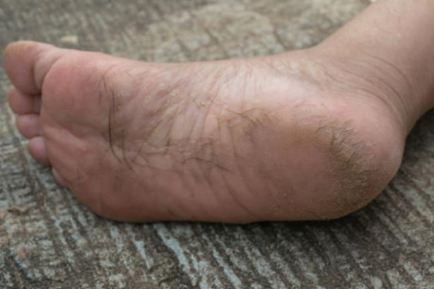 Topuk çatlakları ölümcül hastalığın belirtisi! - 3