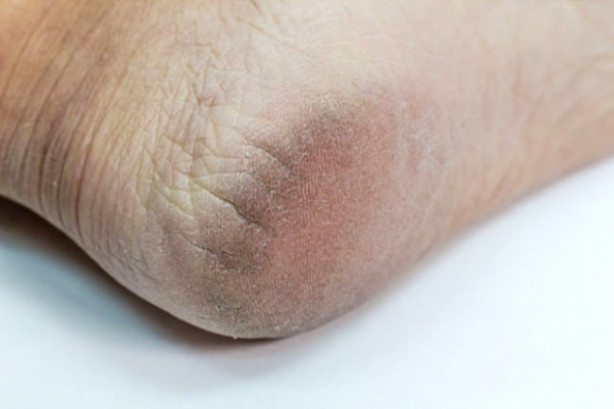 Topuk çatlakları ölümcül hastalığın belirtisi! - 4