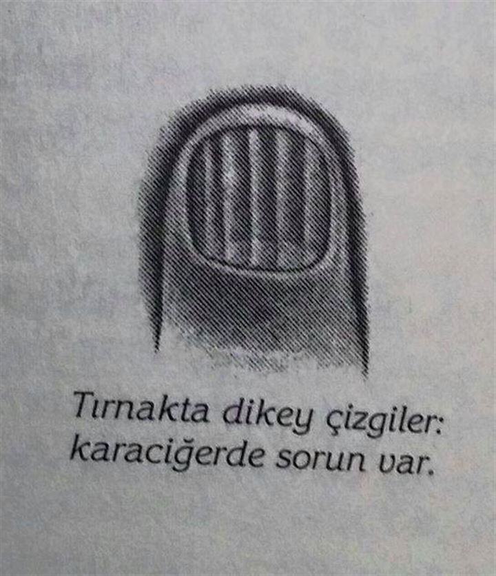 Tırnağınızın şekli hastalık habercisi olabilir - 3