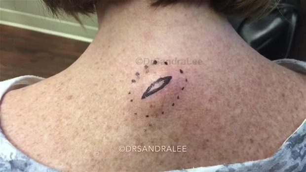 Boynundaki kisti kesti ve... - 1