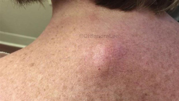 Boynundaki kisti kesti ve... - 2